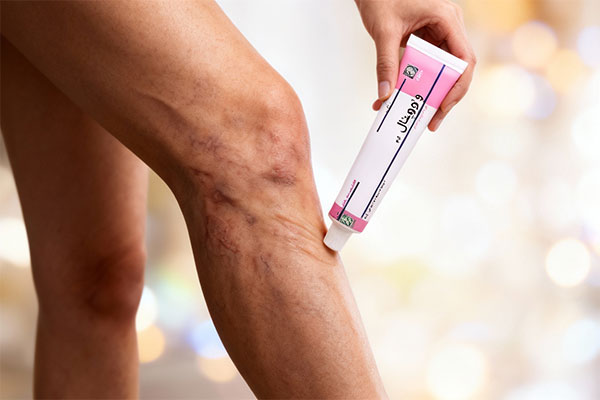 ماساژ کرم ونوویتال دینه روی پای مبتلا به واریس