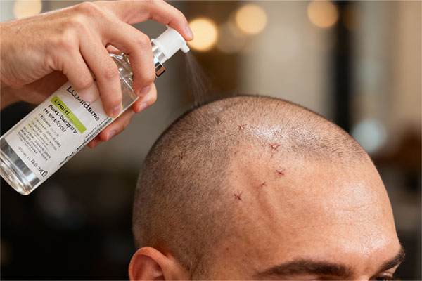 استفاده از لوسیون رطوبت رسان پس از کاشت مو سپیژن برای تسکین پوست سر